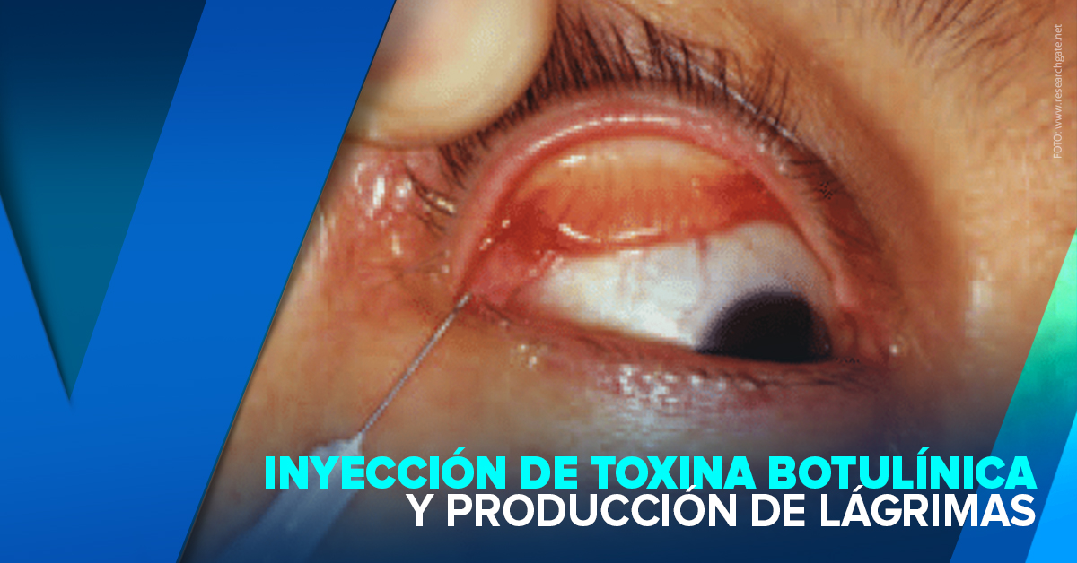 INYECCIÓN DE TOXINA BOTULÍNICA Y PRODUCCIÓN DE LÁGRIMAS