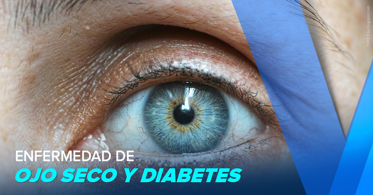 ENFERMEDAD DE OJO SECO Y DIABETES