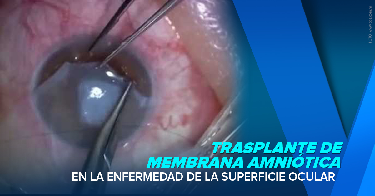 TRASPLANTE DE MEMBRANA AMNIÓTICA EN LA ESO