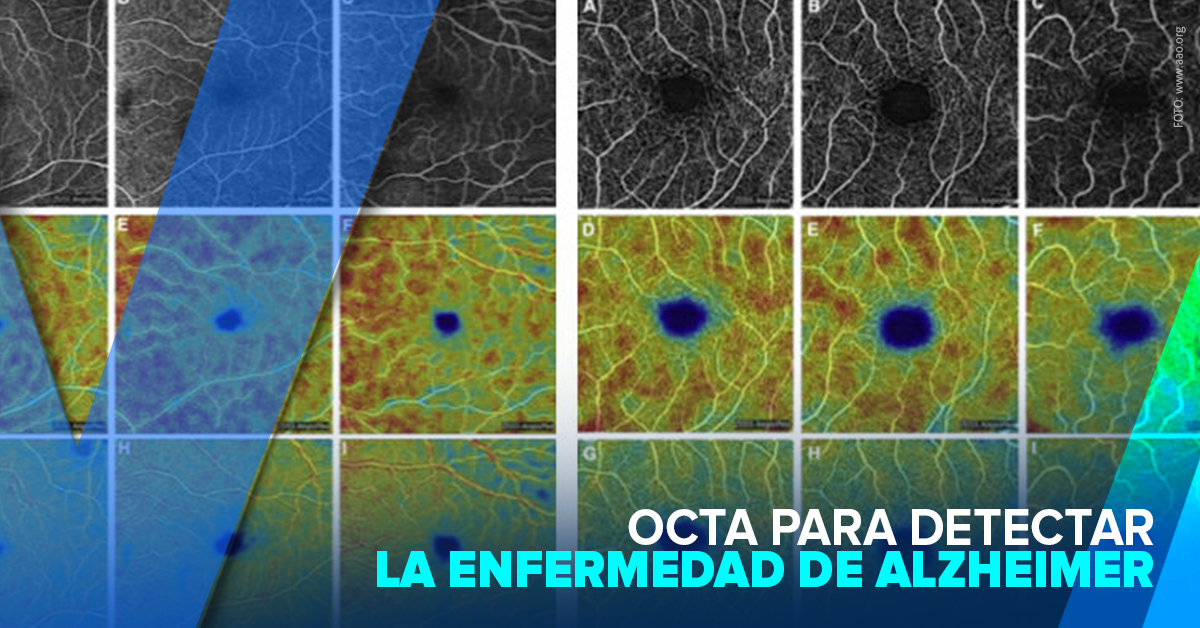 OCTA PARA DETECTAR ENFERMEDAD DE ALZHEIMER