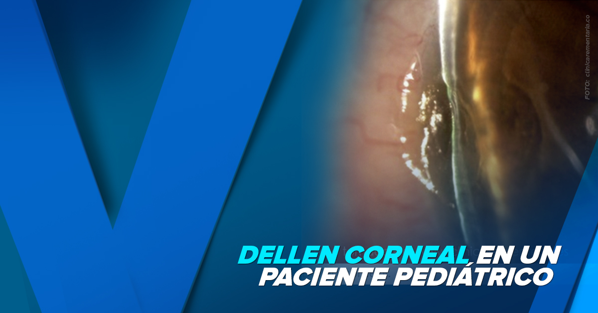 DELLEN CORNEAL EN UN PACIENTE PEDIÁTRICO