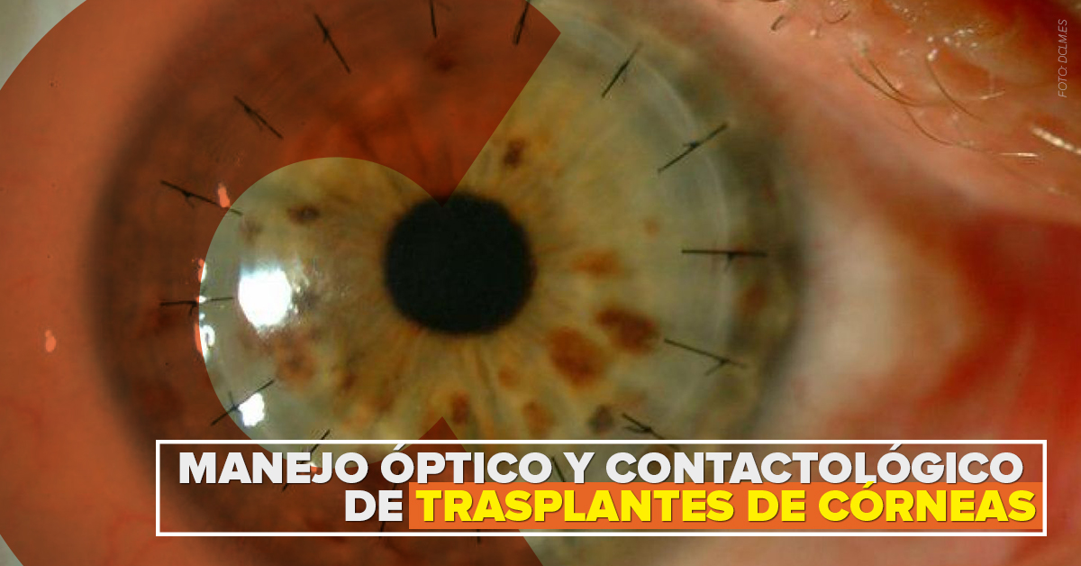 MANEJO ÓPTICO Y CONTACTOLÓGICO DE TRASPLANTES DE CÓRNEAS: