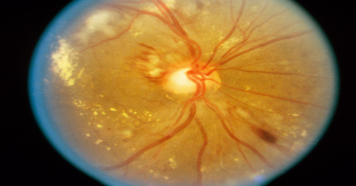 Retinopatía hipertensiva ¿Qué pueden hacer los especialistas?