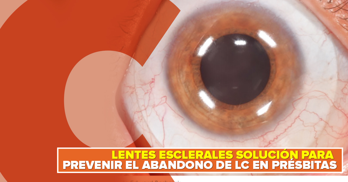 LENTES ESCLERALES SOLUCIÓN PARA PREVENIR EL ABANDONO DE LC EN PRÉSBITAS