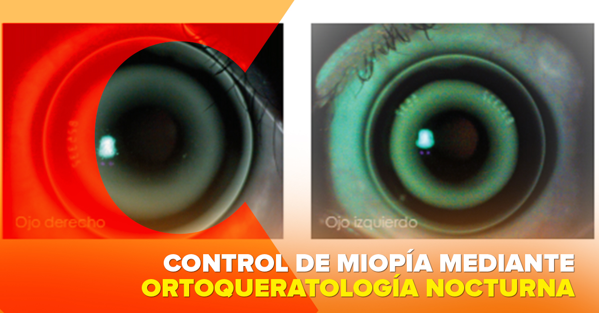 CONTROL DE MIOPÍA MEDIANTE ORTOQUERATOLOGÍA NOCTURNA