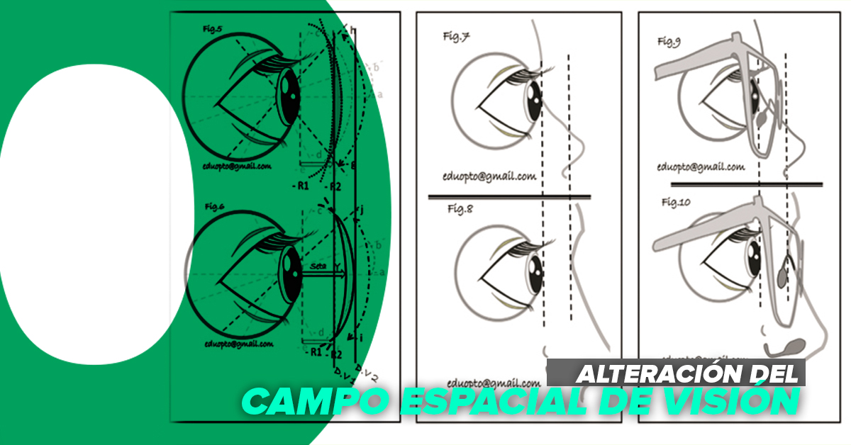 ALTERACIÓN DEL CAMPO ESPACIAL DE VISIÓN