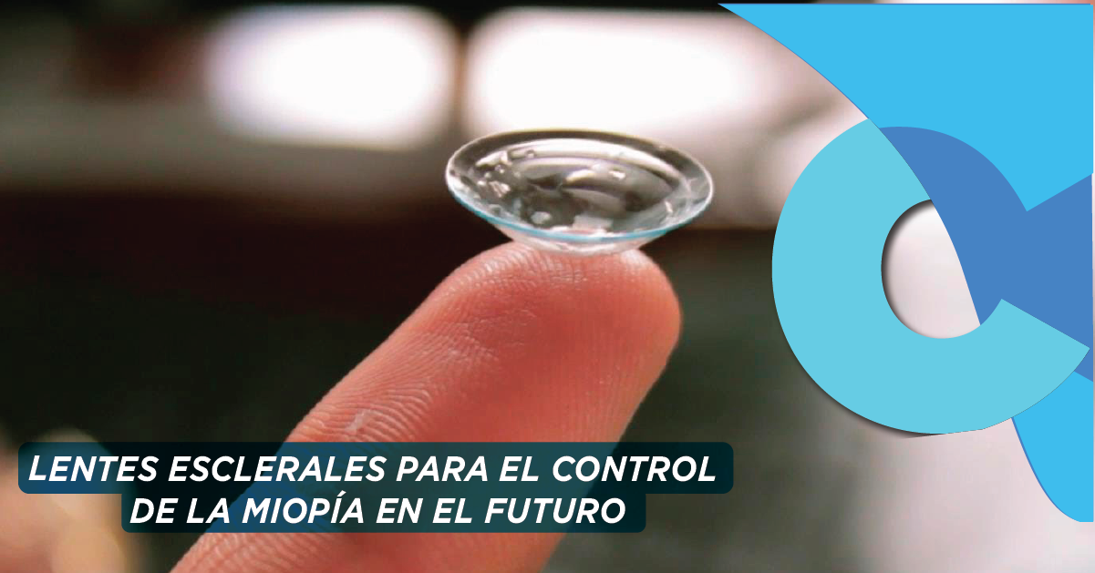 Lentes esclerales para el control de la miopía en el futuro