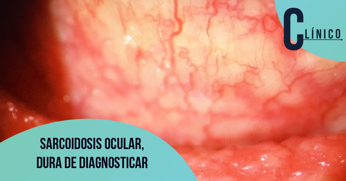 Sarcoidosis ocular, dura de diagnosticar