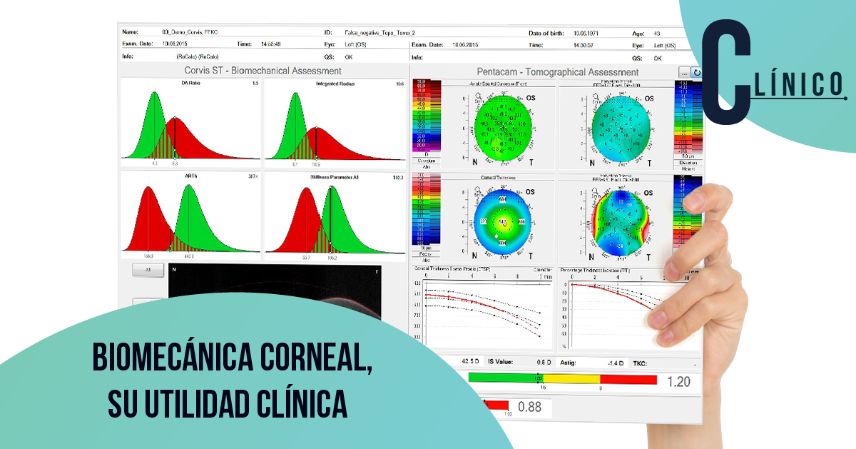 Biomecánica corneal, su utilidad clínica