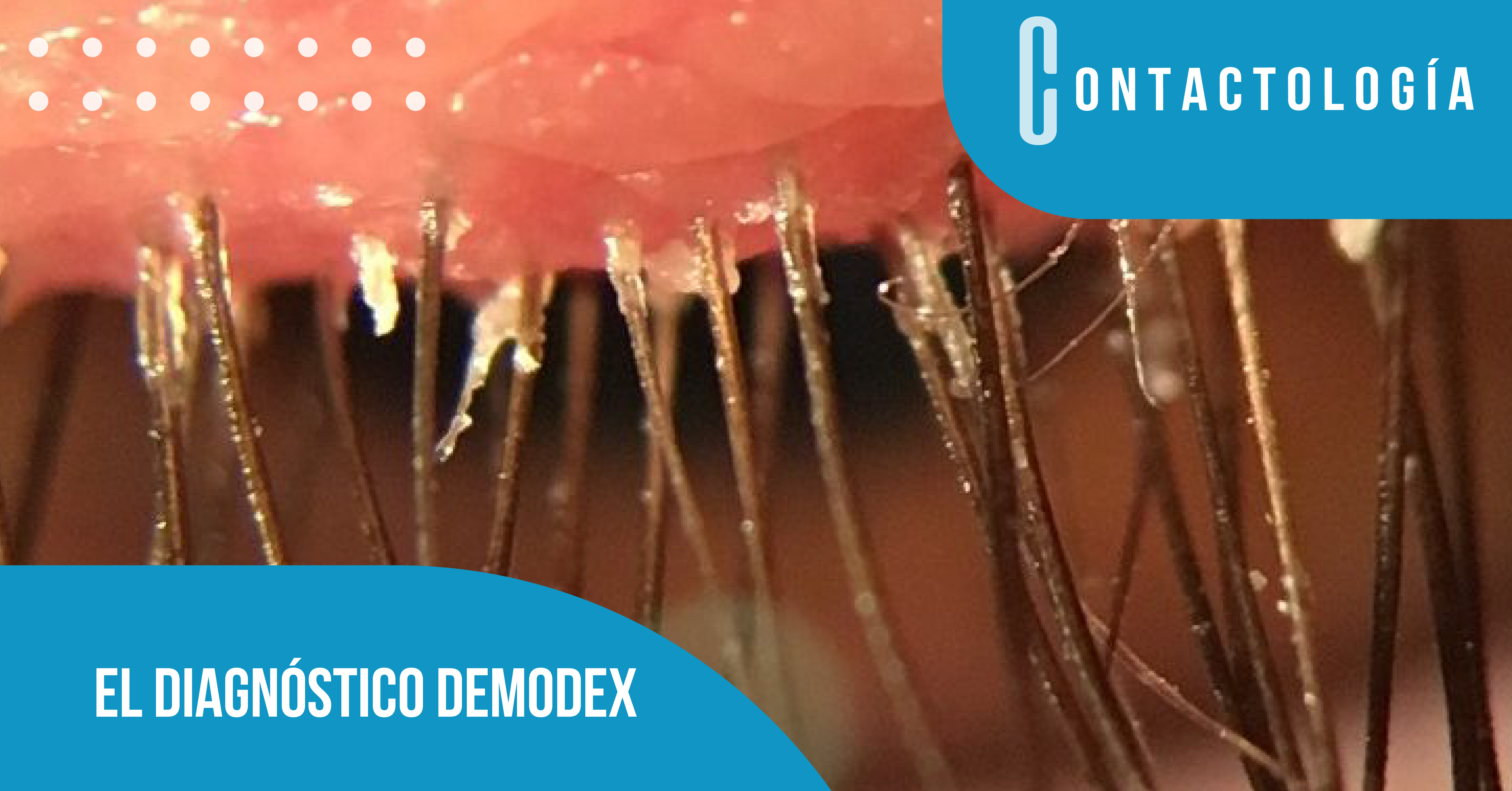 EL DIAGNÓSTICO DEMODEX