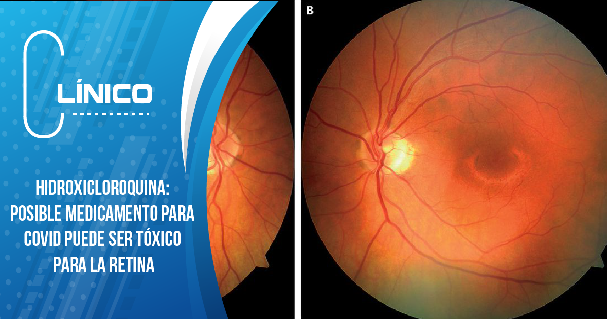 HIDROXICLOROQUINA: POSIBLE MEDICAMENTO PARA COVID PUEDE SER TÓXICO PARA LA RETINA