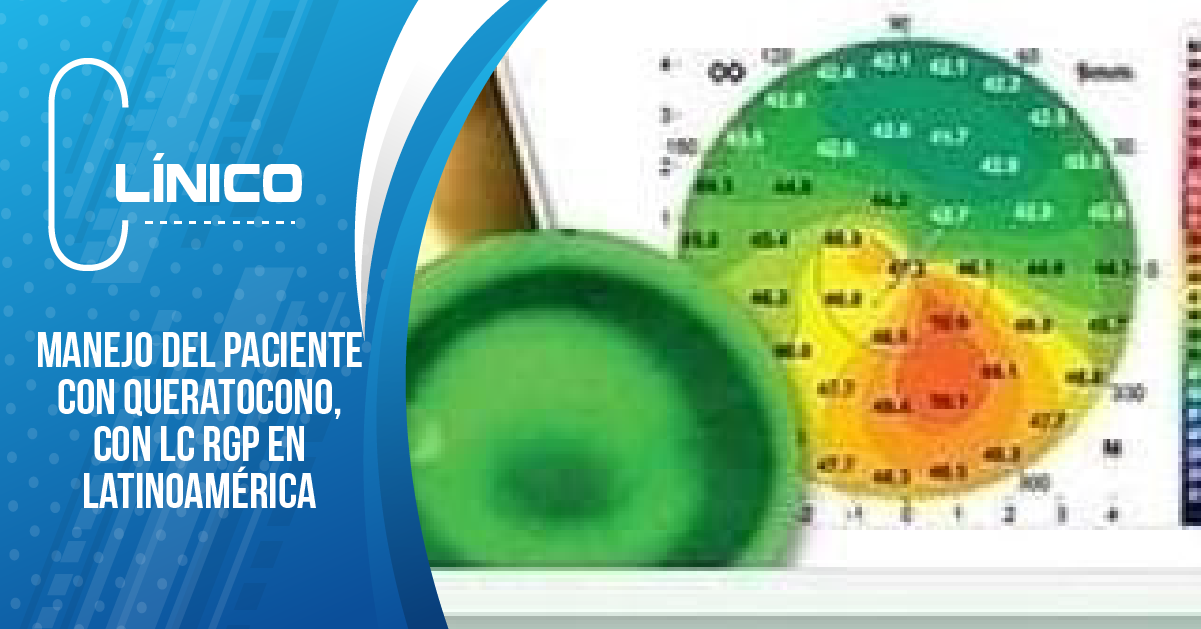 MANEJO DEL PACIENTE CON QUERATOCONO, CON LC RGP EN LATINOAMÉRICA