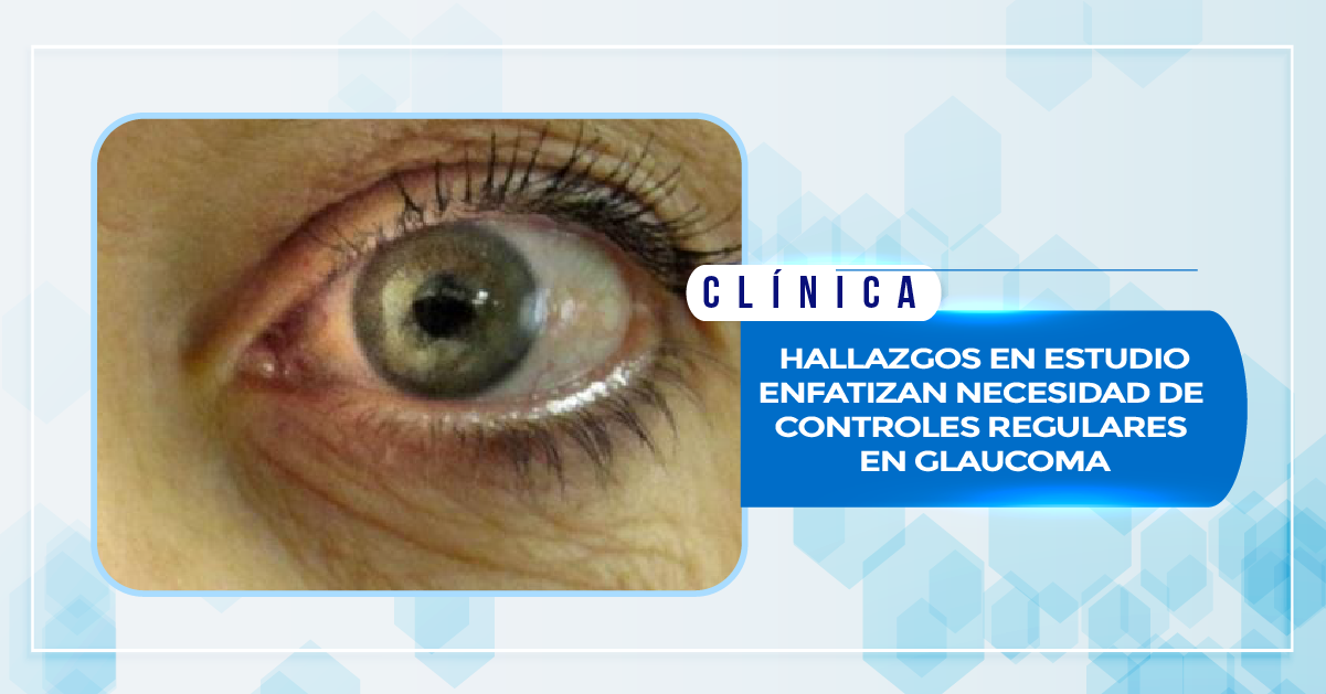 HALLAZGOS EN ESTUDIO ENFATIZAN NECESIDAD DE CONTROLES REGULARES EN GLAUCOMA