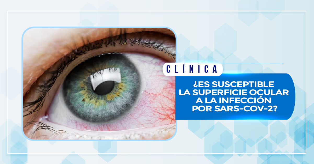 ¿ES SUSCEPTIBLE LA SUPERFICIE OCULAR A LA INFECCIÓN POR SARS-COV-2?