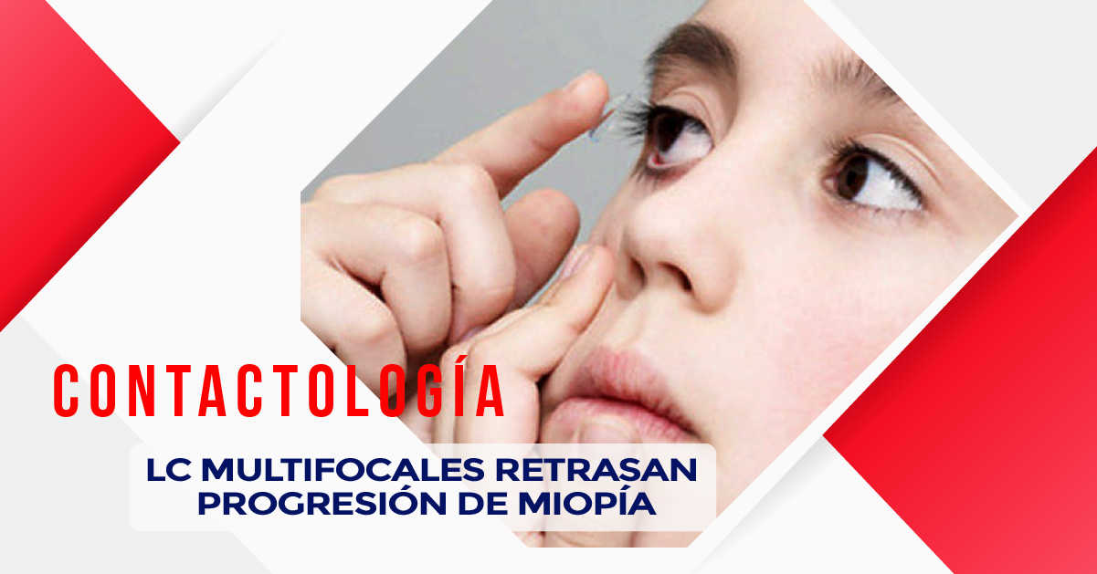 LC MULTIFOCALES RETRASAN PROGRESIÓN DE MIOPÍA