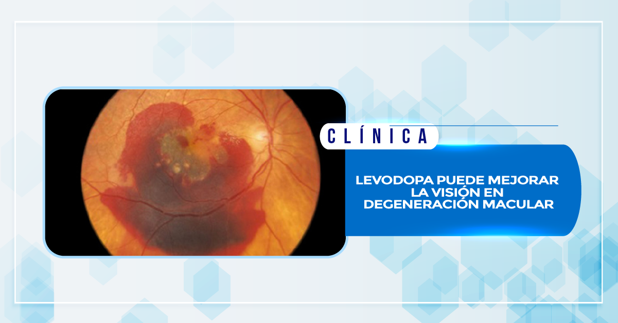 LEVODOPA PUEDE MEJORAR LA VISIÓN EN DEGENERACIÓN MACULAR