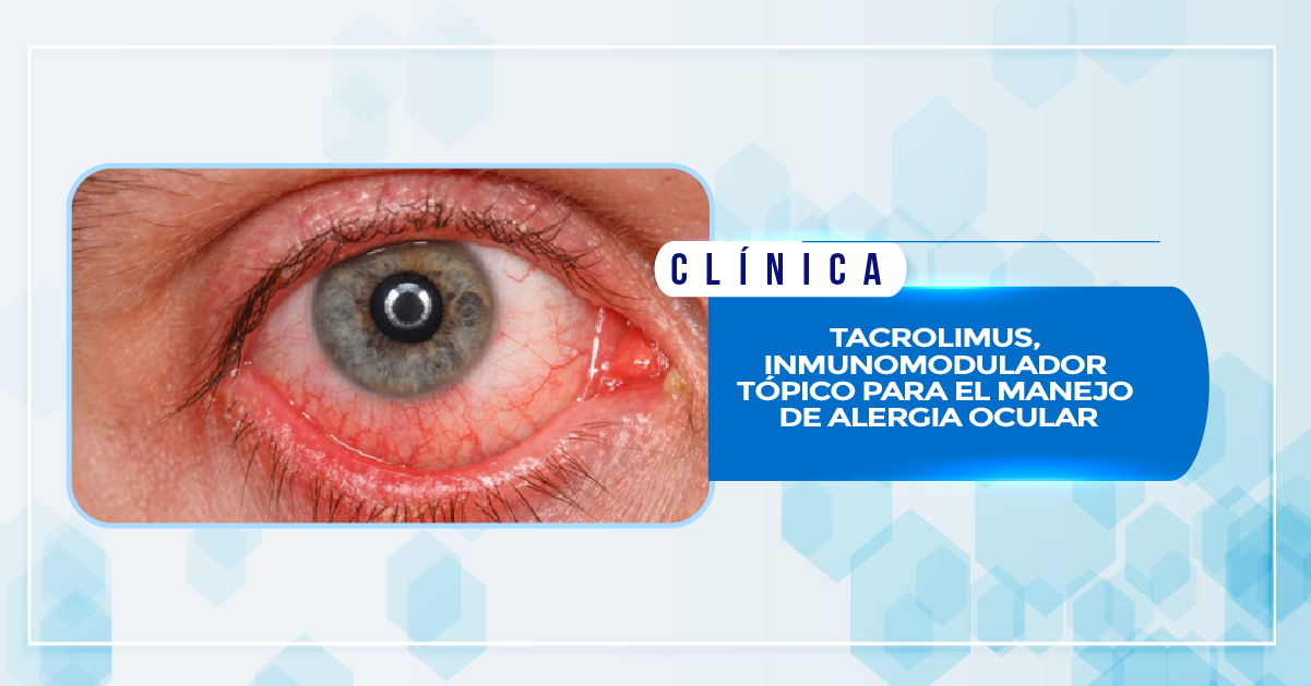 TACROLIMUS, INMUNOMODULADOR TÓPICO PARA EL MANEJO DE ALERGIA OCULAR