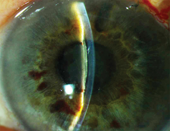 GLAUCOMA MALIGNO