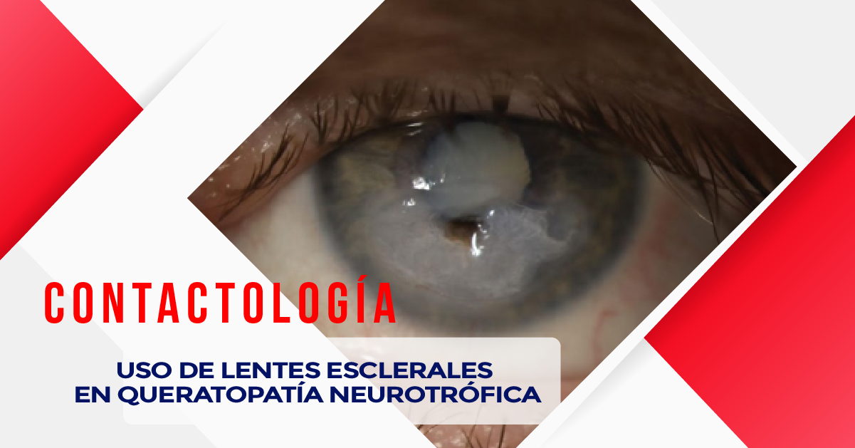 USO DE LENTES ESCLERALES EN QUERATOPATÍA NEUROTRÓFICA