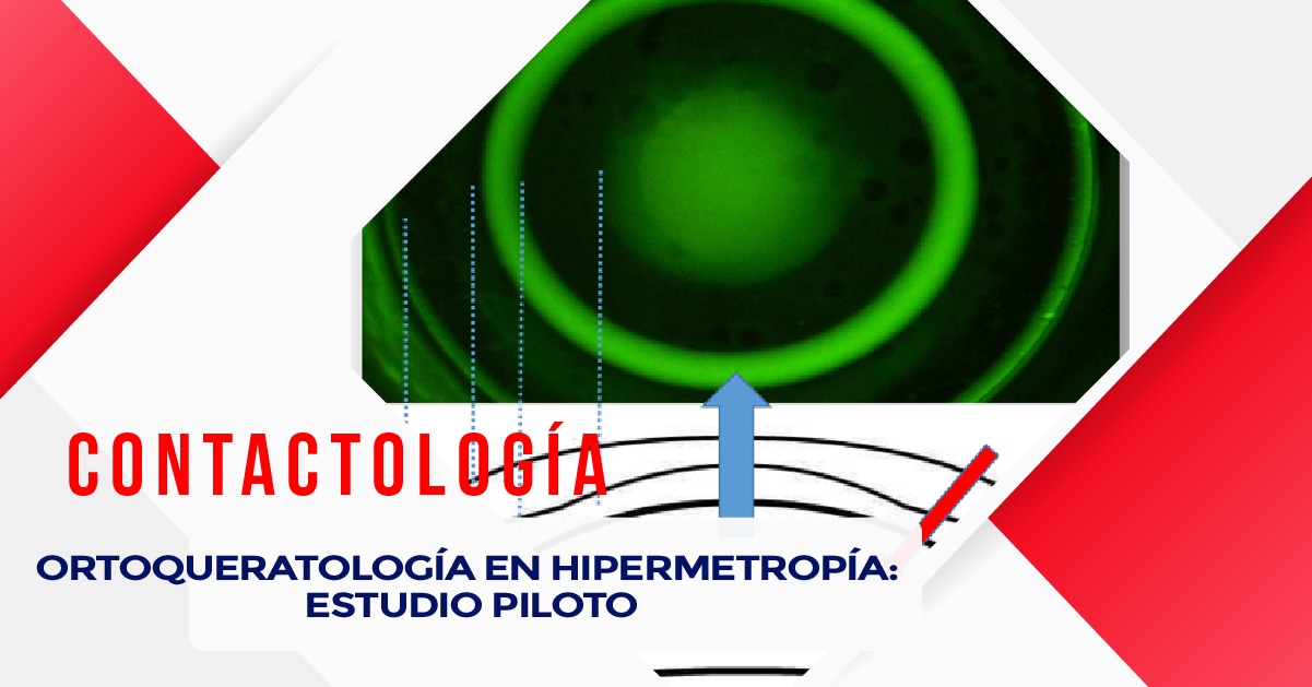 ORTOQUERATOLOGÍA EN HIPERMETROPÍA: ESTUDIO PILOTO