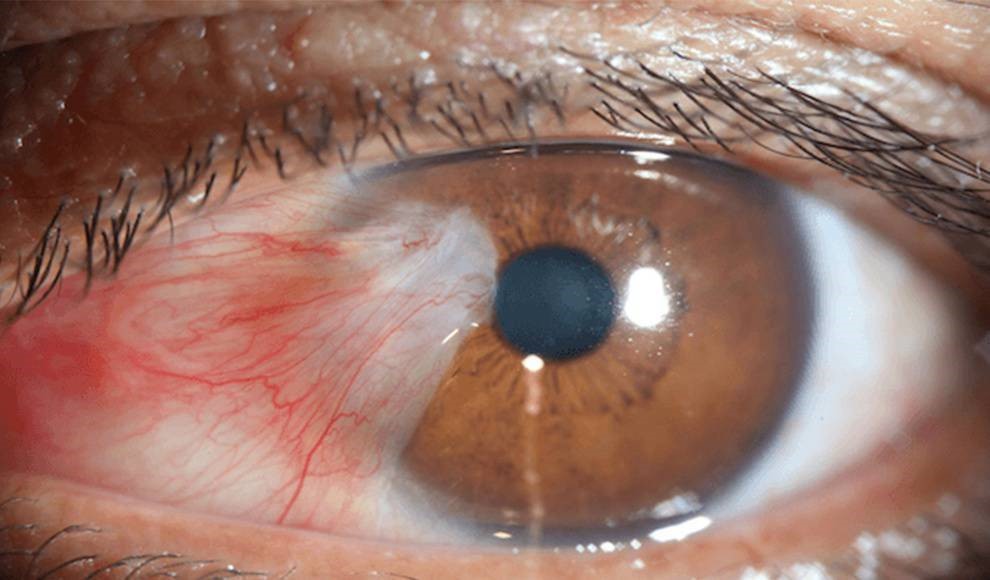 RADIACIÓN UV Y PTERIGIUM DESDE UNA PERSPECTIVA MOLECULAR