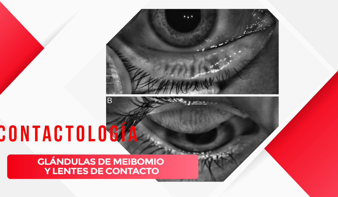 GLÁNDULAS DE MEIBOMIO Y LENTES DE CONTACTO