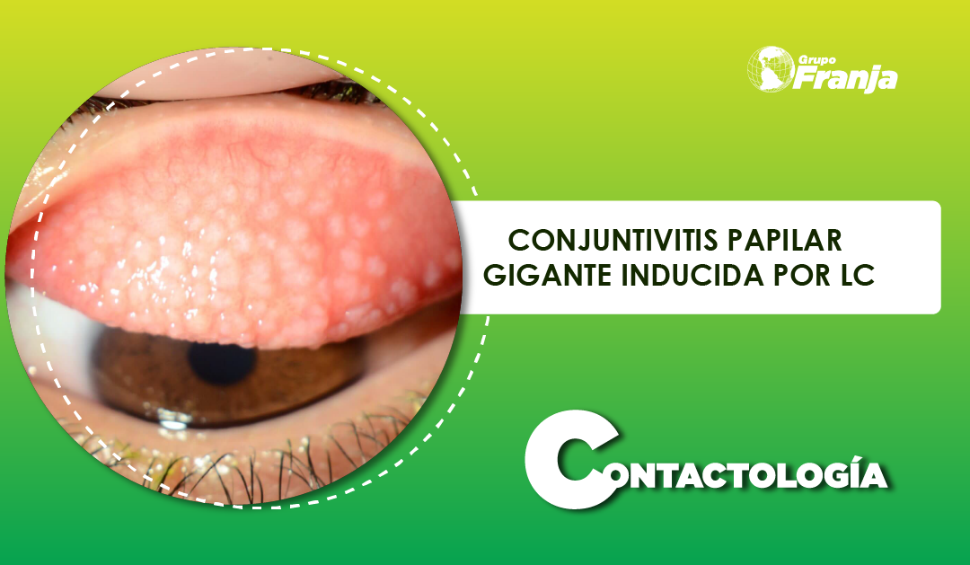 CONJUNTIVITIS PAPILAR GIGANTE INDUCIDA POR LC