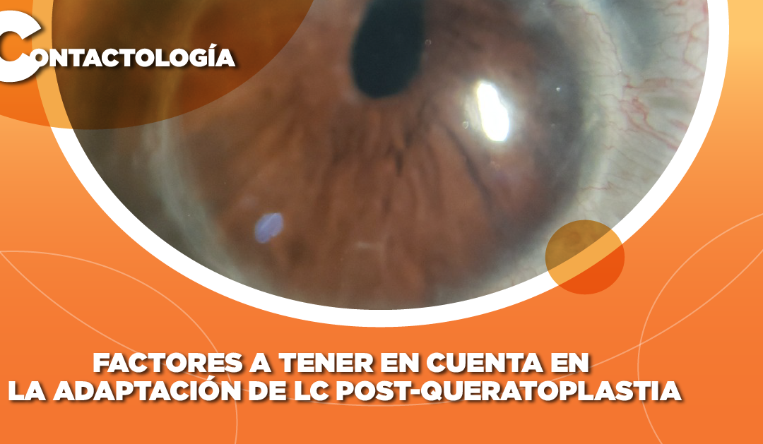 FACTORES A TENER EN CUENTA EN LA ADAPTACIÓN DE LC POST-QUERATOPLASTIA