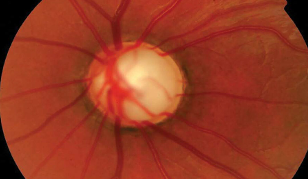 Relación entre presión arterial y glaucoma, aún un enigma
