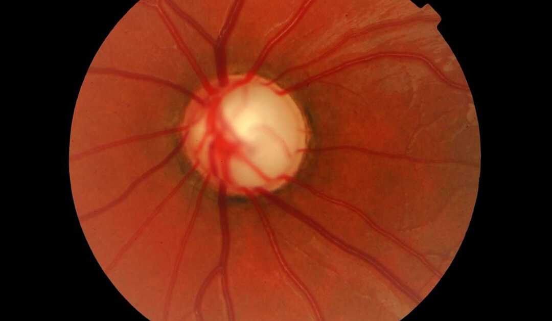 Glaucoma avanzado, un abordaje de sus fundamentos
