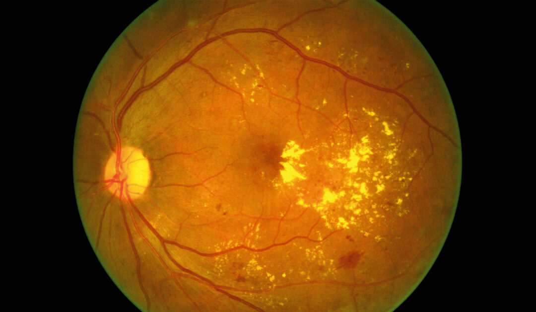 Biomarcadores en el edema macular diabético