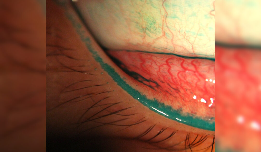 Uso de lentes de contacto y su relación con Epiteliopatía Lid Wiper