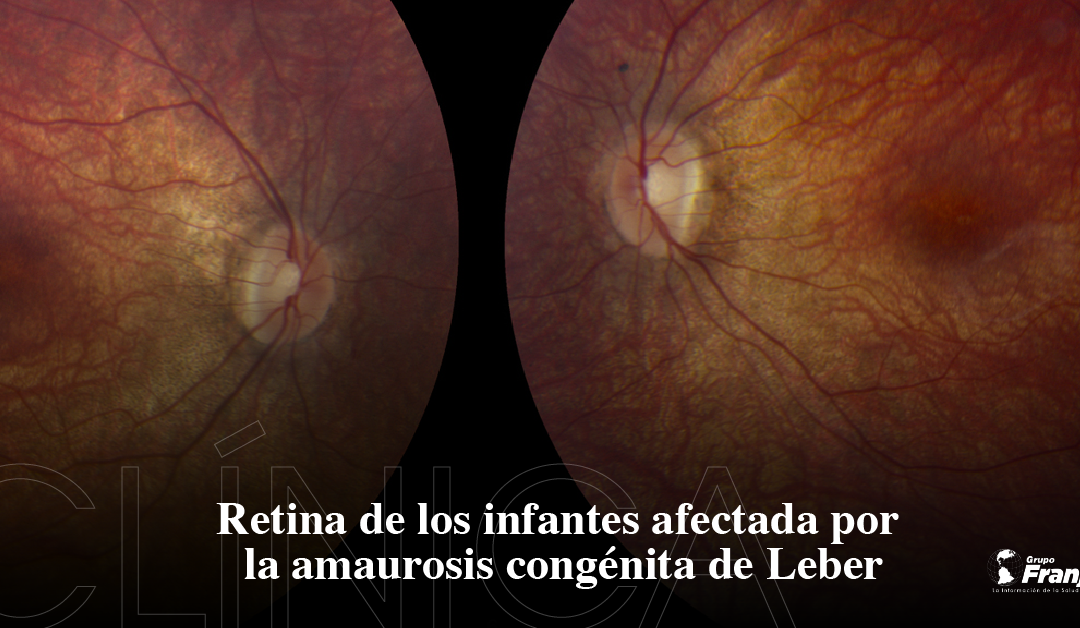 Retina de los infantes afectada por la amaurosis congénita de Leber
