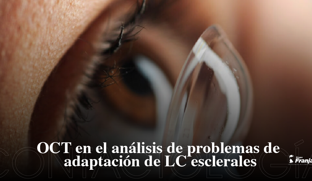 OCT en el análisis de problemas de adaptación de LC esclerales