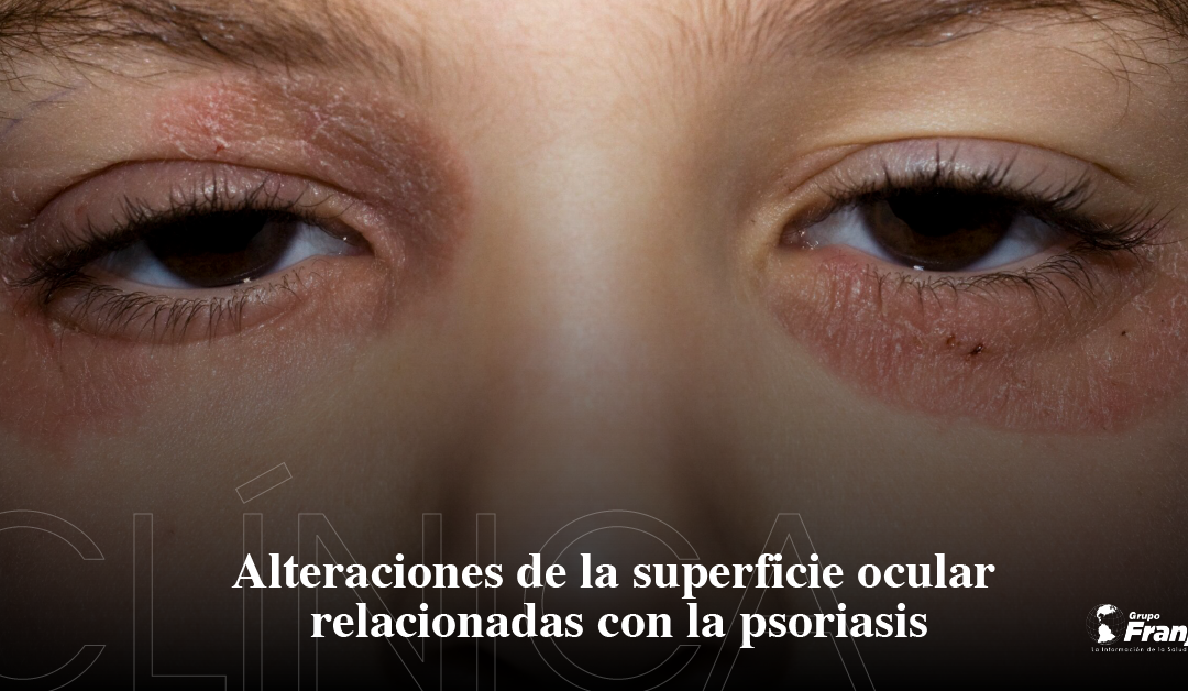 Alteraciones de la Superficie Ocular relacionadas con la psoriasis