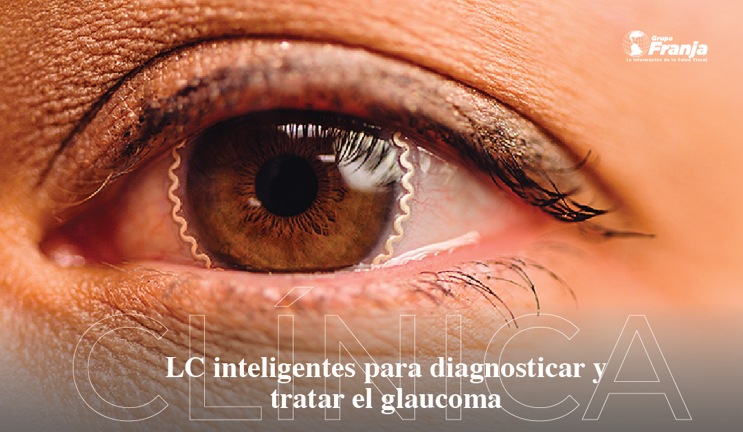 LC inteligentes para diagnosticar y tratar el glaucoma