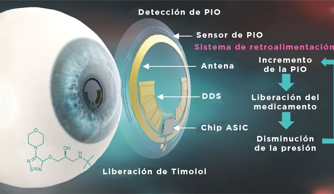 Nuevo LC inteligente para vigilar y controlar la presión intraocular en el glaucoma
