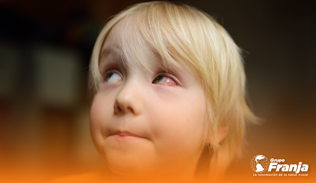 Manifestaciones oculares de enfermedad hepática en niños