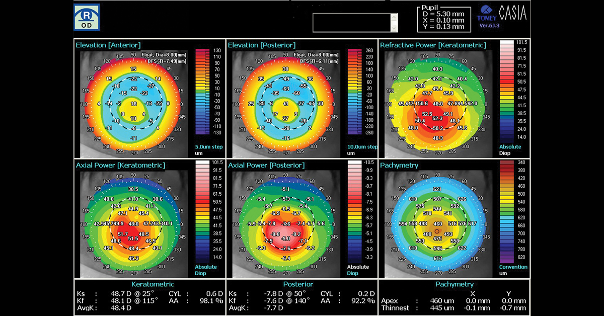 Uso de la topografía corneal para evaluar los LC para el manejo de la miopía