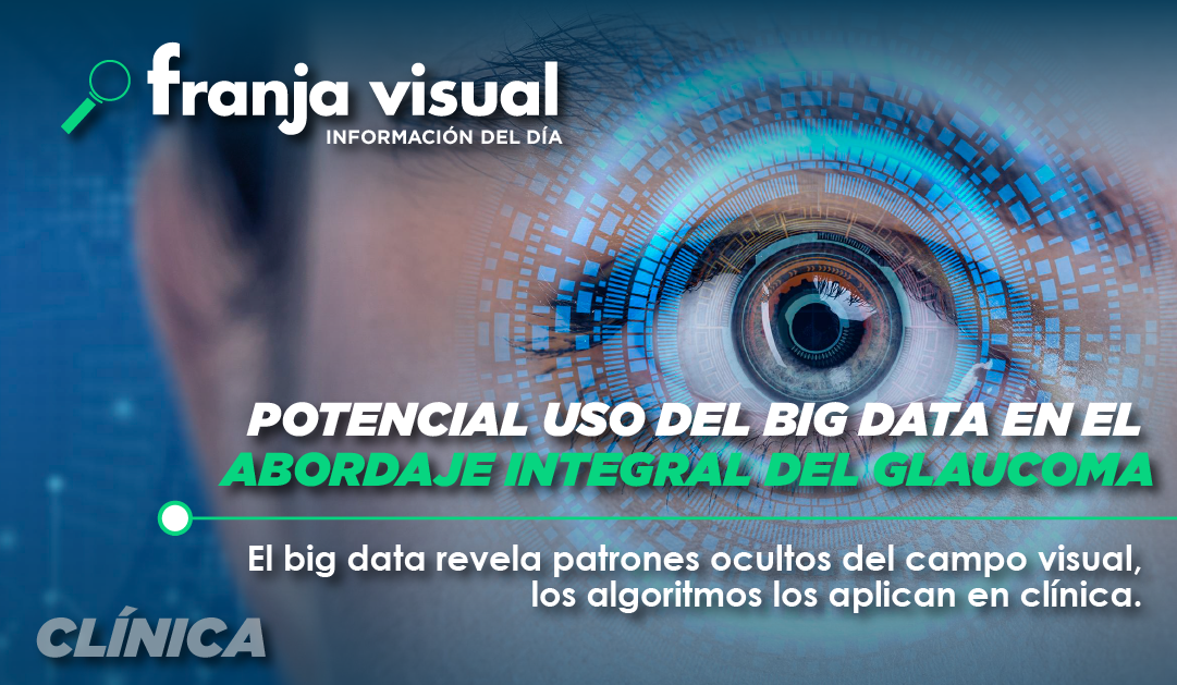 Potencial uso del big data en el abordaje integral del glaucoma
