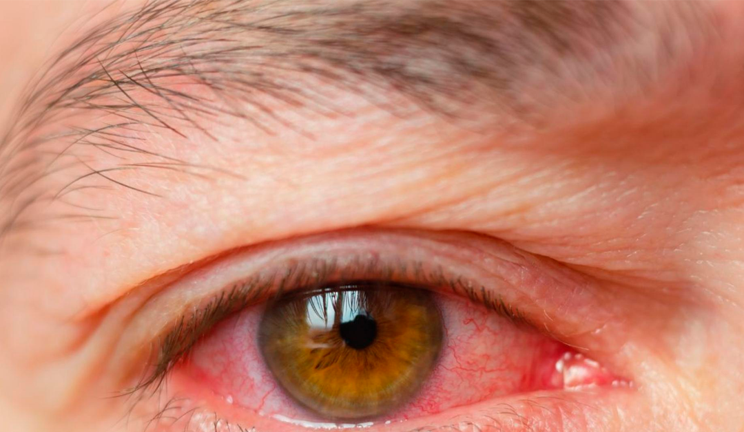 Viruela símica ocular, a propósito de un caso en consulta de optometría