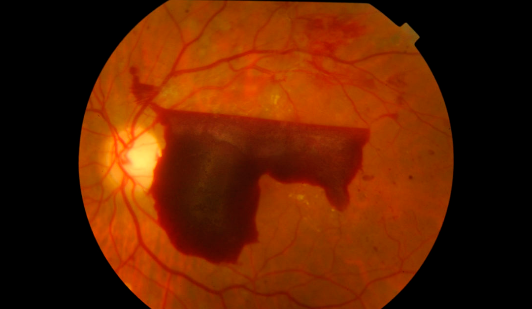 Reflexiones sobre retinopatía diabética