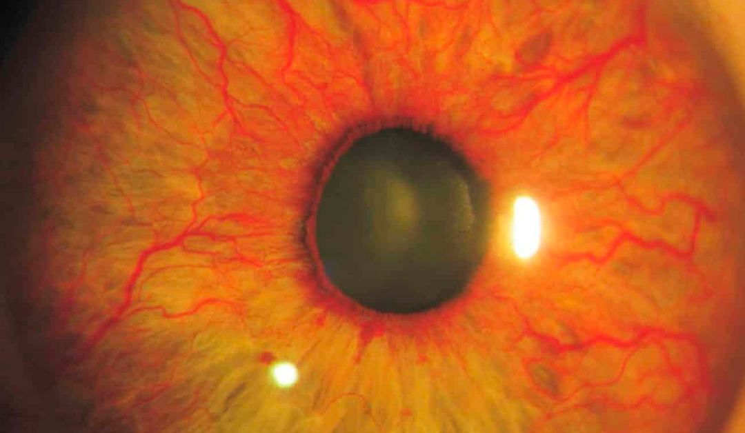 Patogénesis del glaucoma neovascular. Un proceso complejo