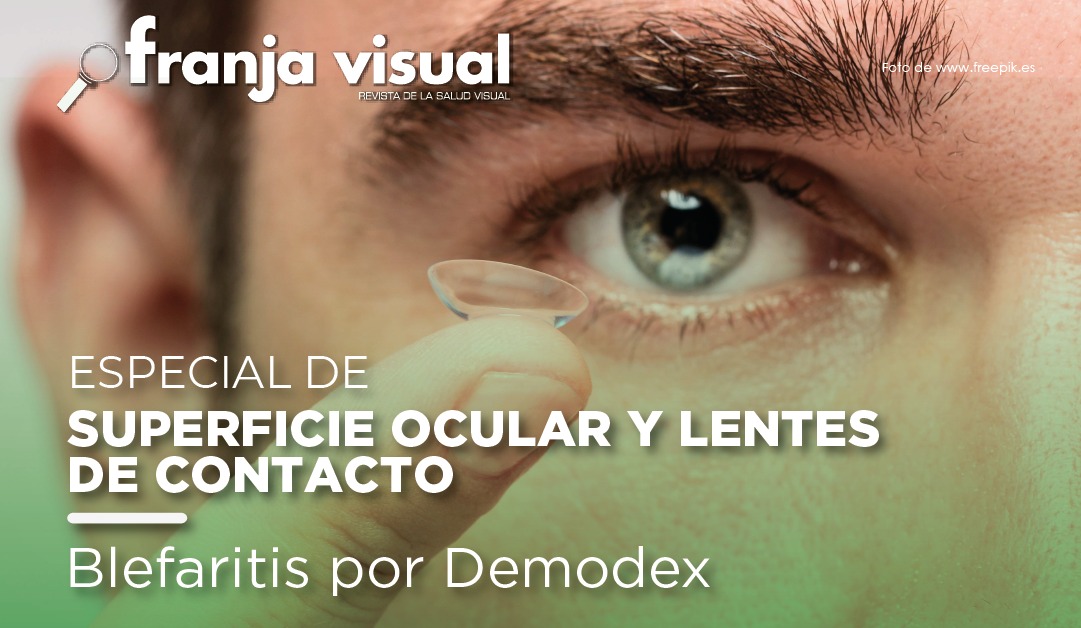 Especial de Superficie Ocular y LC: Blefaritis por Demodex