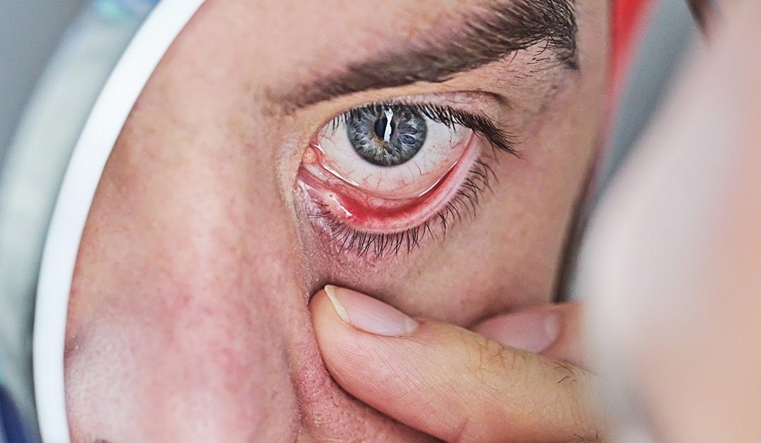 Sistemas gelificantes y LC con antihistamínicos como tratamientos de la alergia ocular