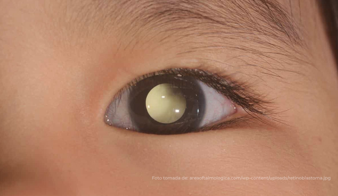 Close-up of a child's eye showing a white pupillary reflex (leukocoria), which can indicate retinoblastoma or other eye conditions.