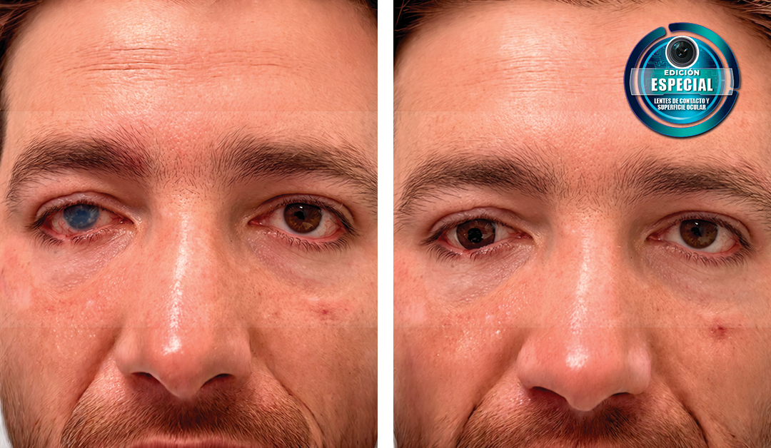 Before-and-after close-up of a man's face showing eye improvement; left eye cloudy, right eye clear; badge in the top-right corner.