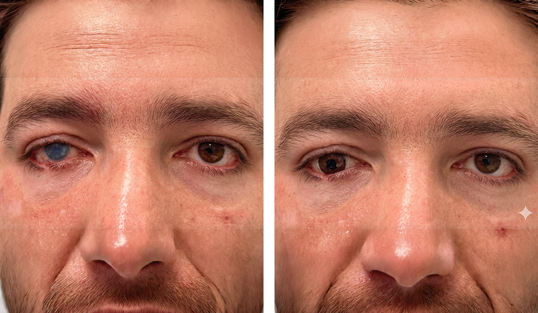 Before-and-after close-up of a man's face showing left eye with a cloudy blue cornea (before) and after treatment with a clear left eye (after); facial hair visible and minor facial skin marks.