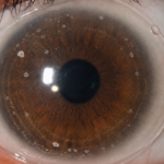 Depósitos de proteínas y lípidos en lentes de contacto blandos: de la cantidad a su relevancia clínica