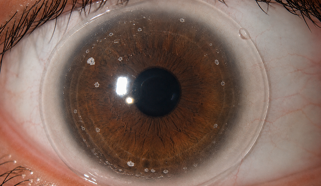 Close-up macro of a brown eye with a clear contact lens and light reflections on the cornea.